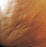 Cellulitis5 Blog